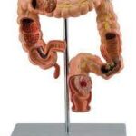 PATHOLOGICAL MODEL OF THE RECTUM