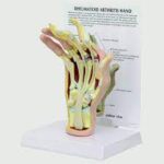 Modelo de mano con artritis reumatoide